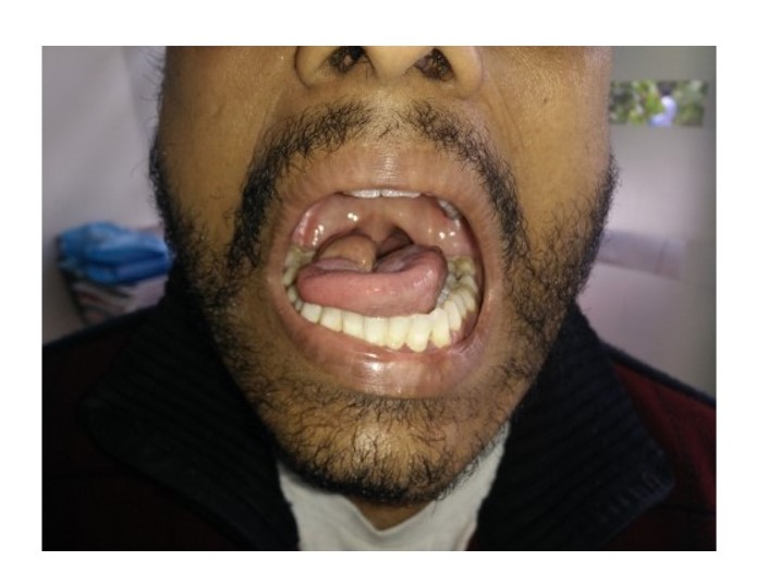 Tongue Cancer Treatment in KPHB