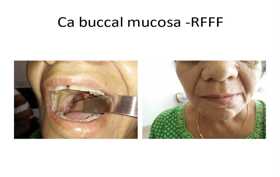 Buccal mucosa cancer surgery in KPHB