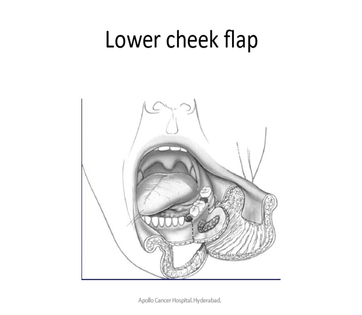Buccal mucosa cancer surgery in KPHB