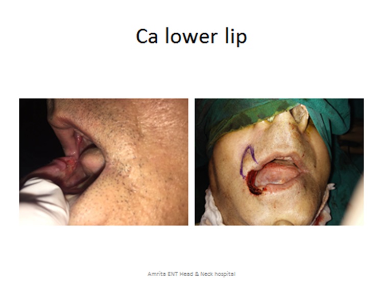 Lip Cancer specilist doctor in KPHB