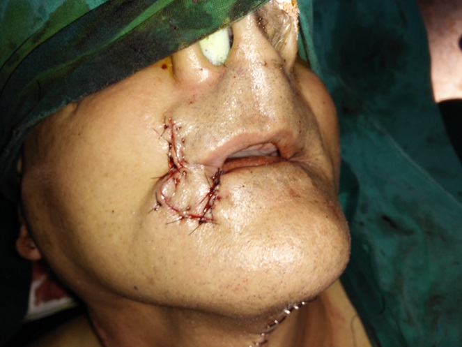 Lip Cancer Treatment in KPHB