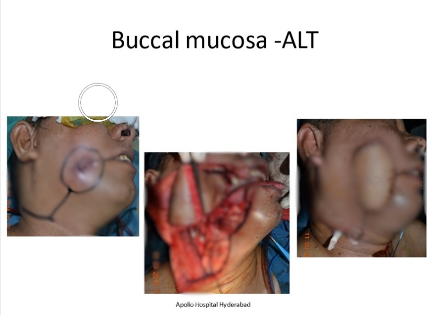 Buccal mucosa cancer treatment in KPHB
