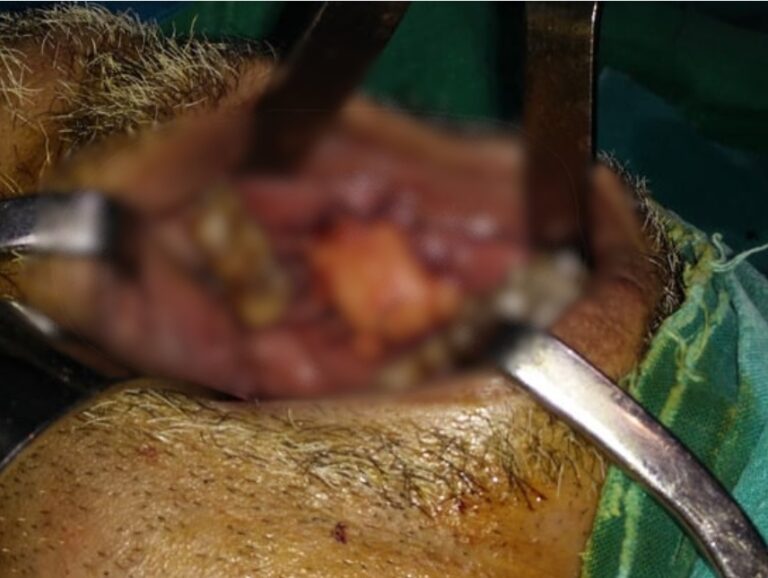 Buccal mucosa cancer treatment in KPHB