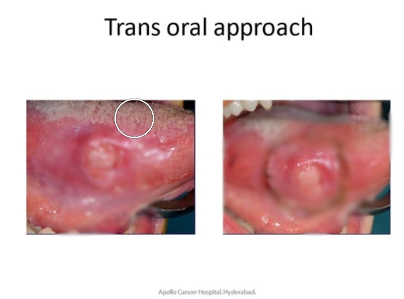 Tongue Cancer Treatment in KPHB