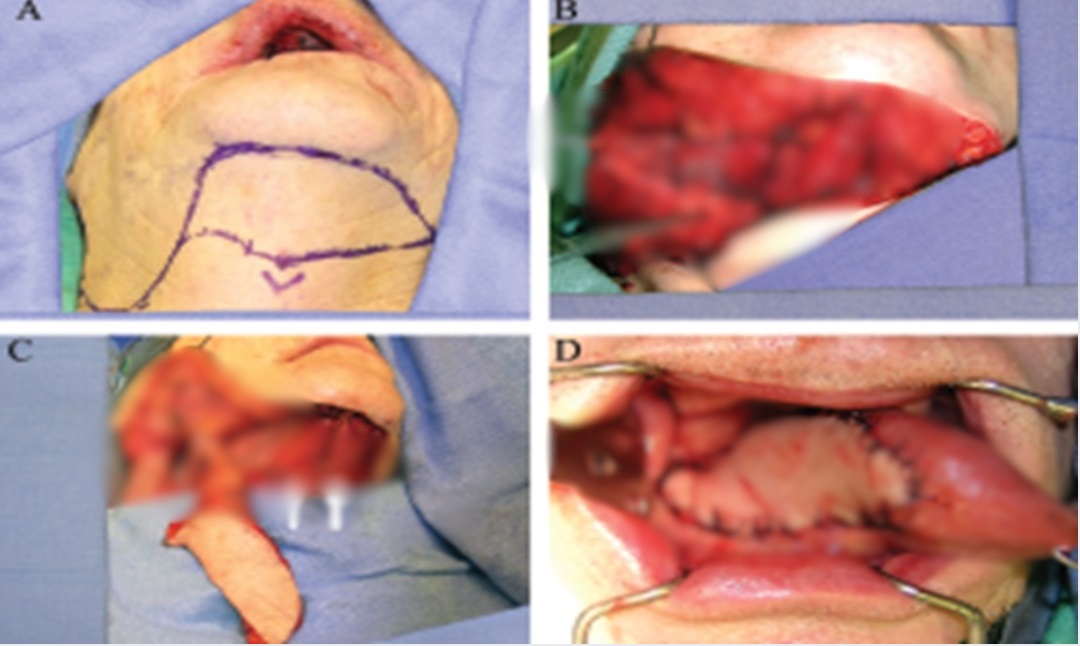 Tongue Cancer Treatment in KPHB