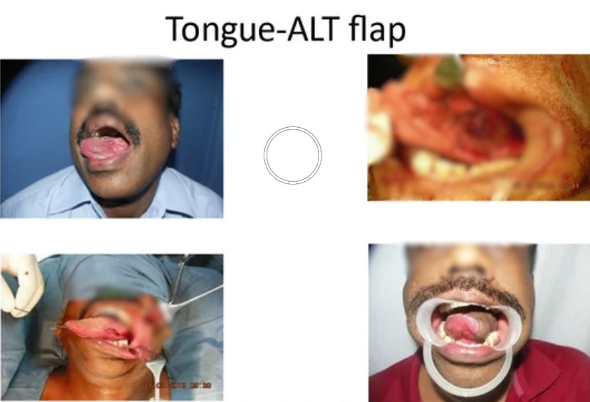 Tongue Cancer Treatment in KPHB