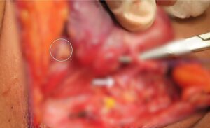 Thyroid Cancer Treatment in KPHB