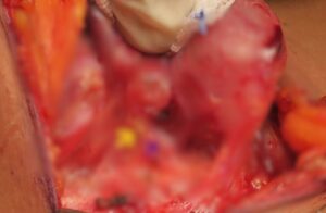 Thyroid Cancer Treatment in KPHB