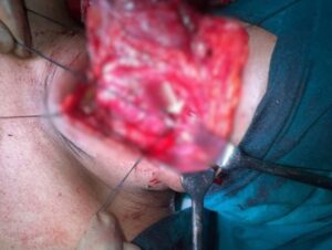 Thyroid Cancer Treatment in KPHB