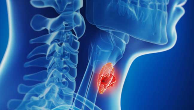 Thyroid Cancer